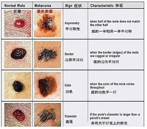 腰上長痣|腰上有這顆痣的人天生財運佳，命里藏金，家財萬貫